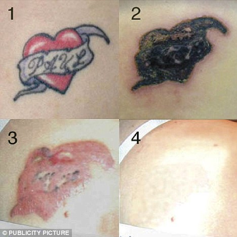 White Tattoo On Dark Skin. Unwanted Tattoos Can Be