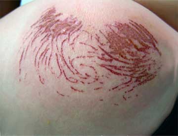 Stings on a 2-Year-Old’s Bottom
