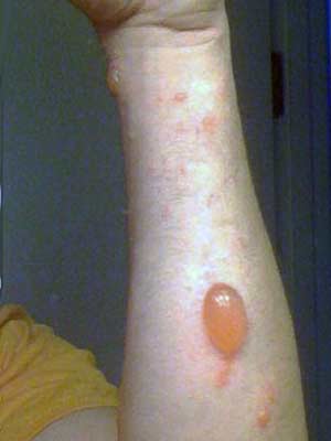 Typical Urushiol Skin Blisters