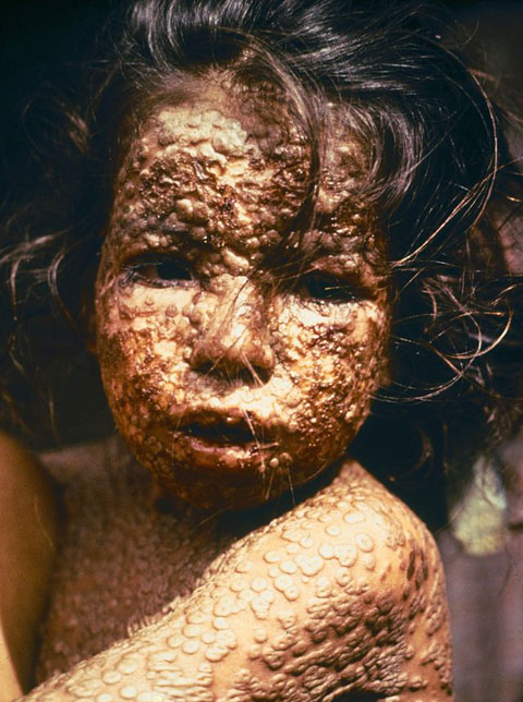 Child infected with smallpox. Bangladesh, 1973.